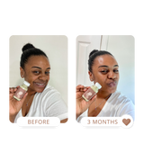 hyperpigmentation treatment for melanin skin, dry skin treatment, dewy skin, skincare for melanin skin