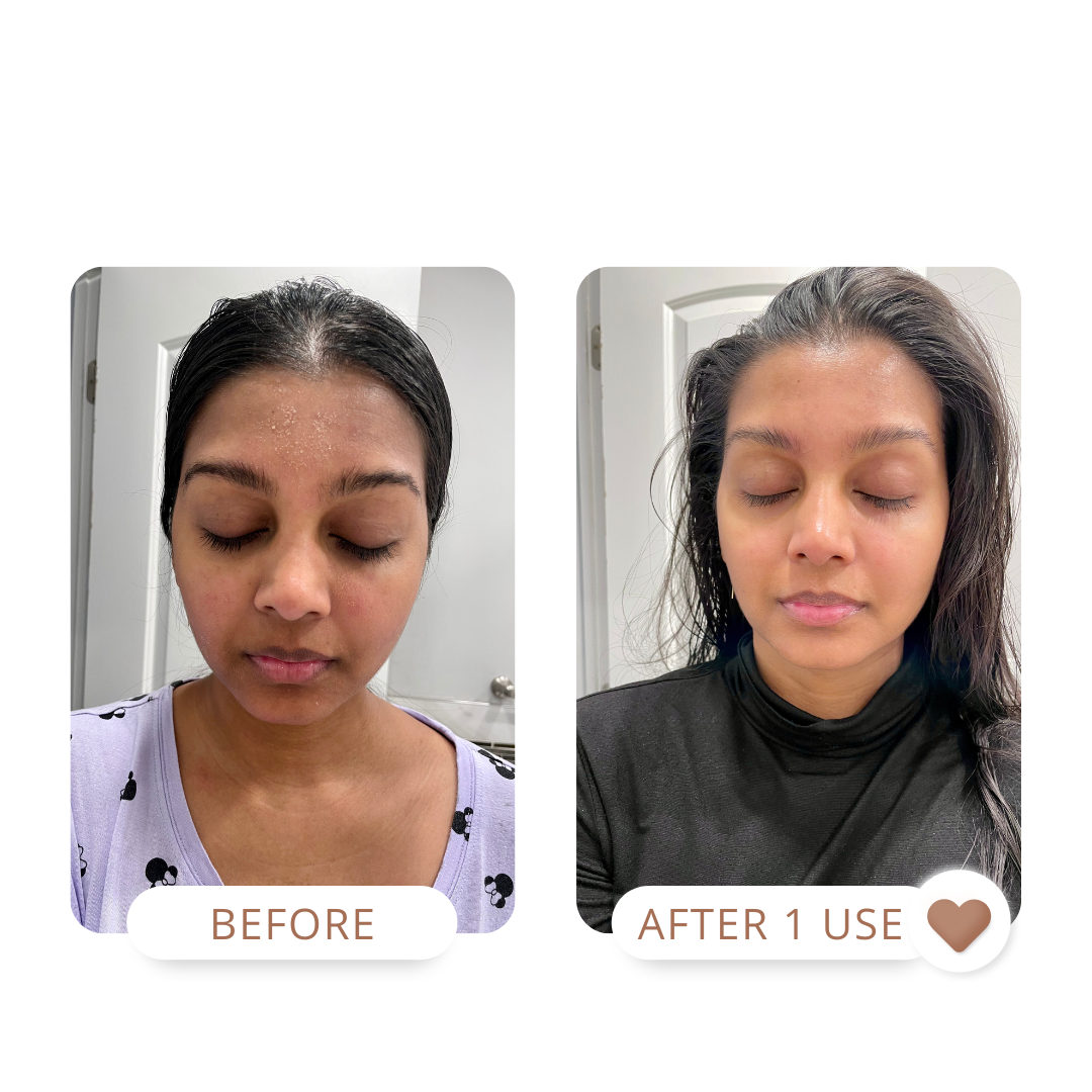 Dry skin facial mask, hyperpigmentation treatment, dull skin, acne transformation, acne treatment, glass skin