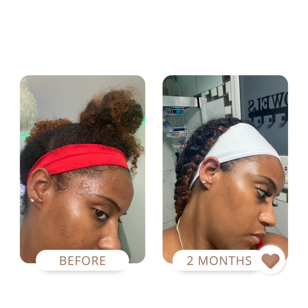 acne treatment, congested pores, dermatitis, melanin skin, hyperpigmentation treatment